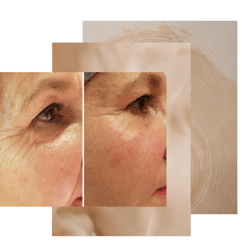 Avant et après un traitement du contour des yeux avec Dermotechnology chez le Bistro de la Beauté