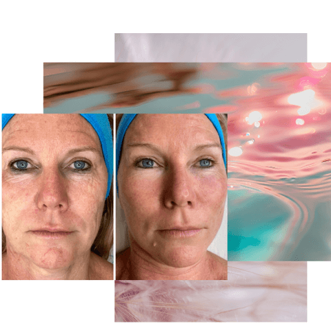 Avant et après traitement du visage avec Dermotechnology chez le Bistro de la Beauté