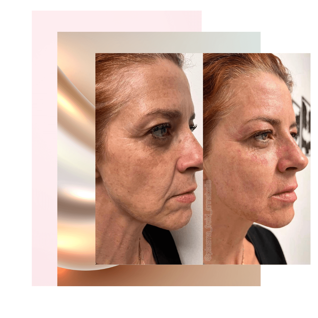 Avant et après le traitement Plasma russe